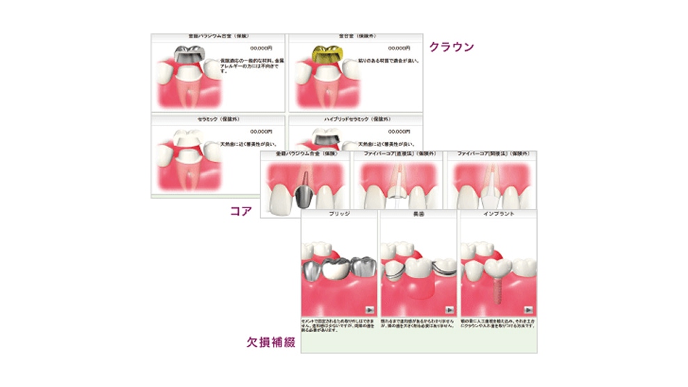 補綴物の比較や予防の説明